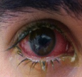 Adenoviral conjunctivitis