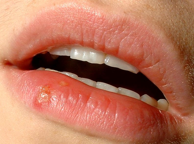 Herpes labialis cold sore