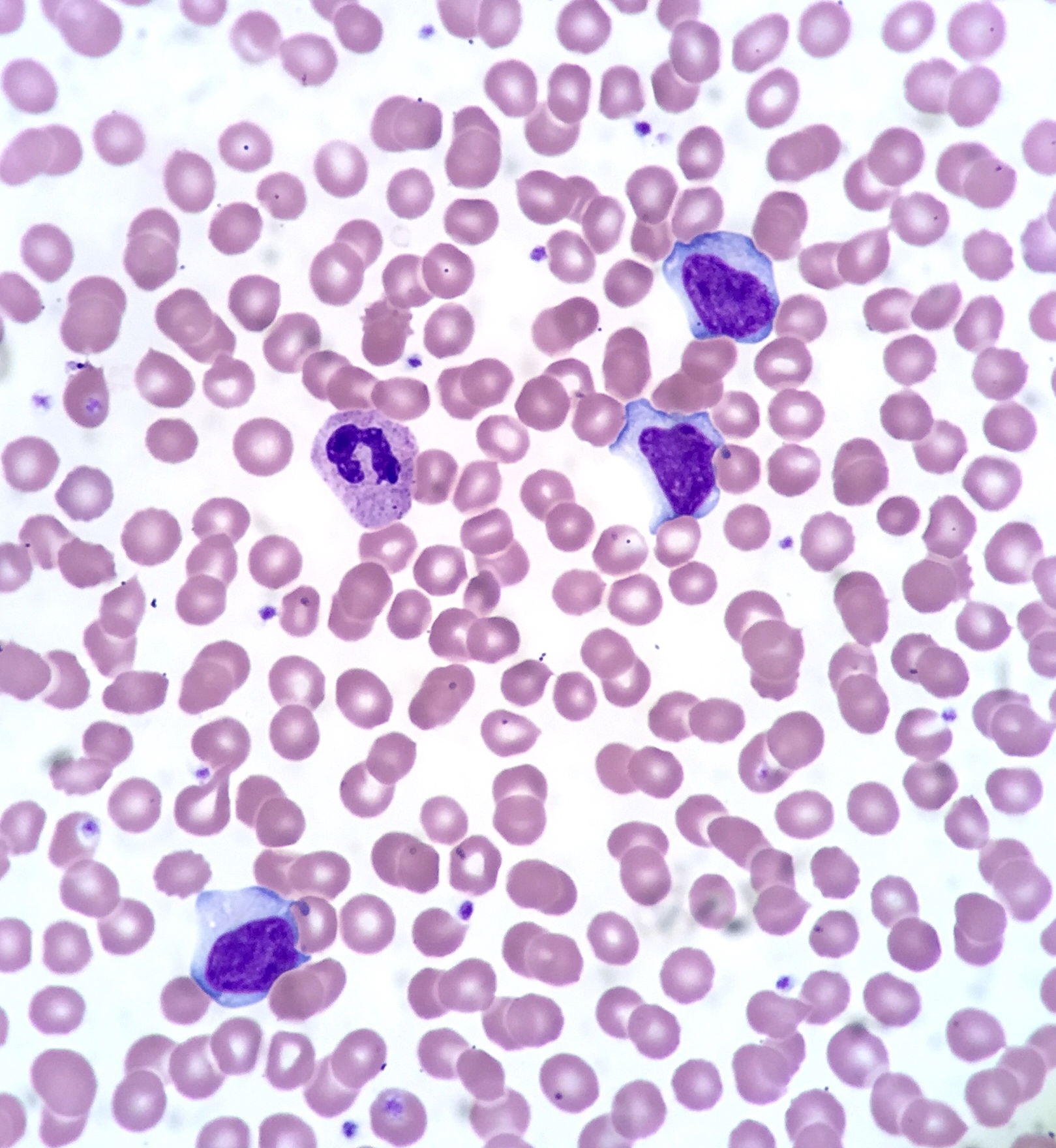 Downey cell (atypical lymphocyte)