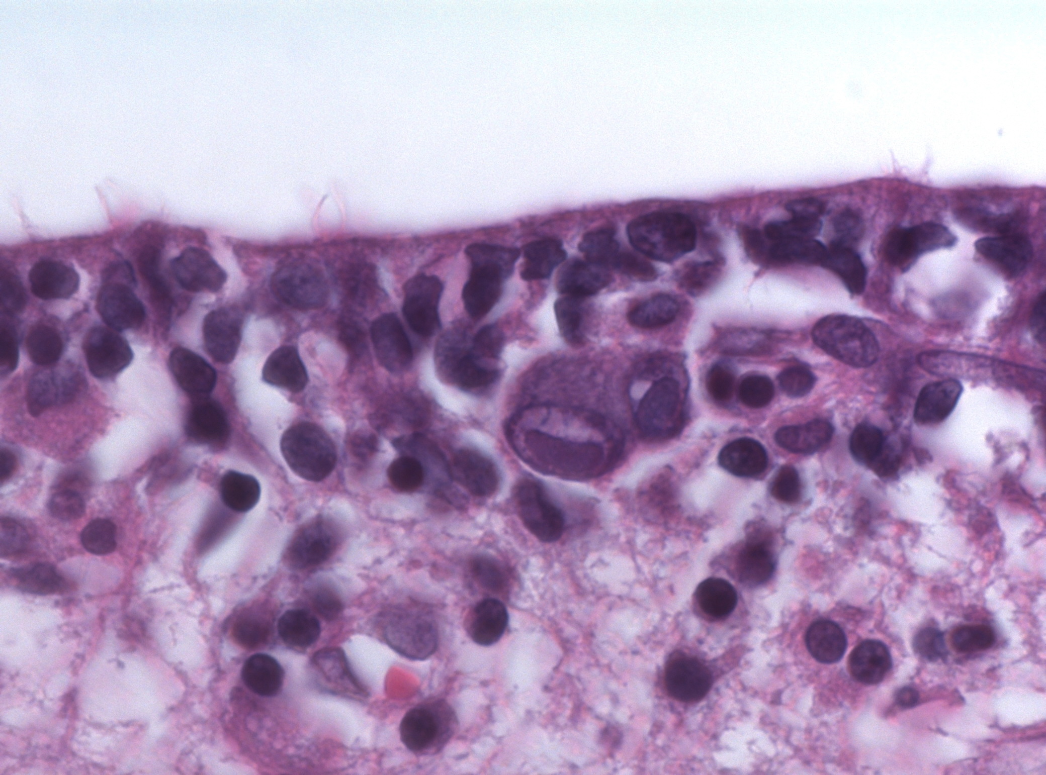 CMV owl-eye intranuclear inclusions