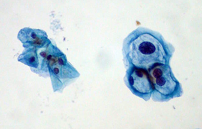 Koilocytes on Pap smear