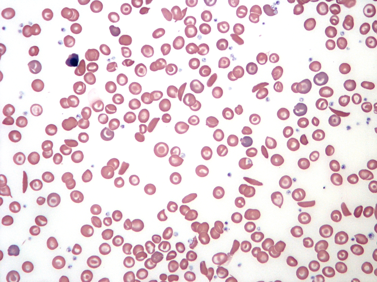 Sickle cells on peripheral smear