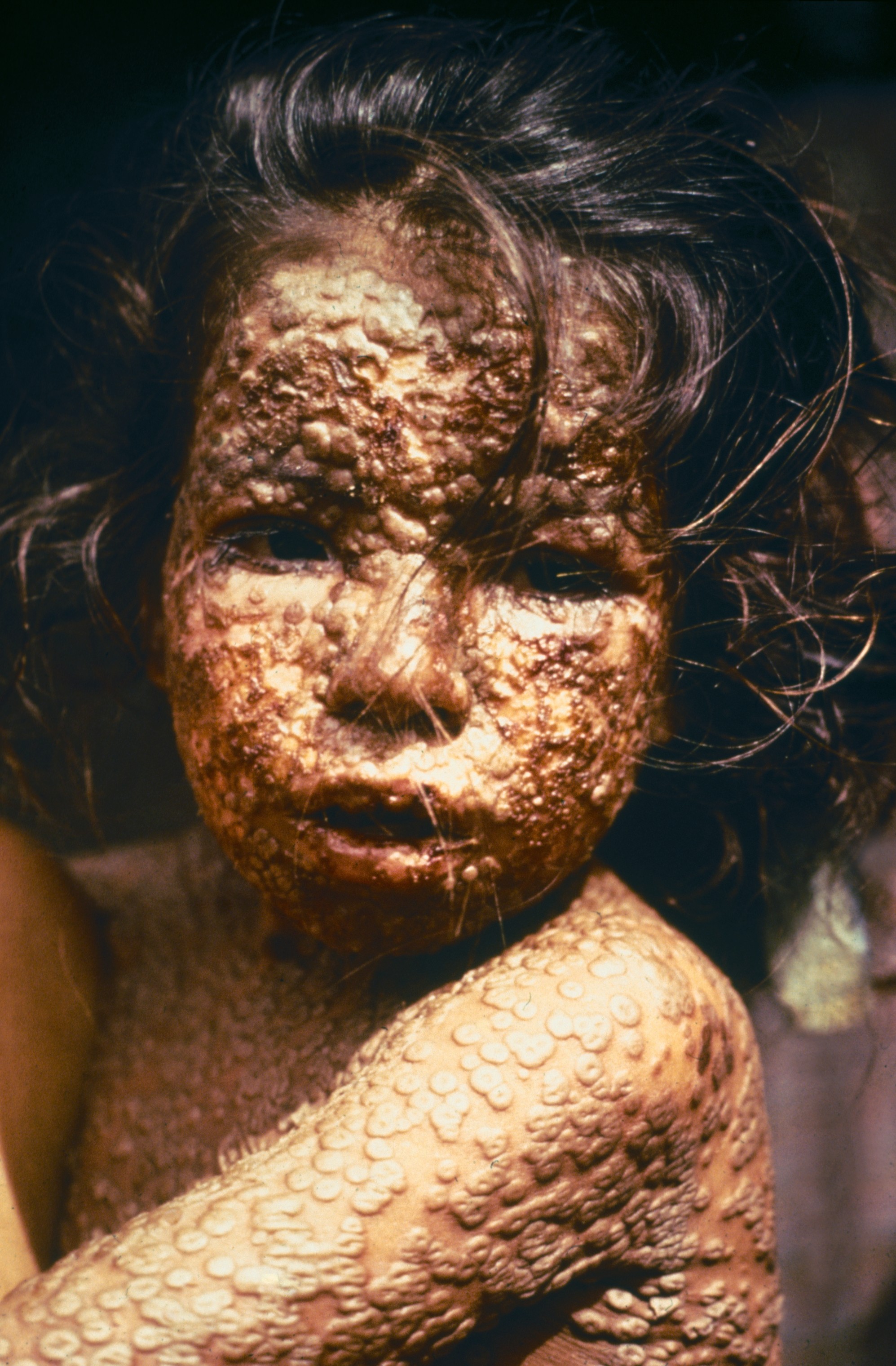 Child with smallpox lesions