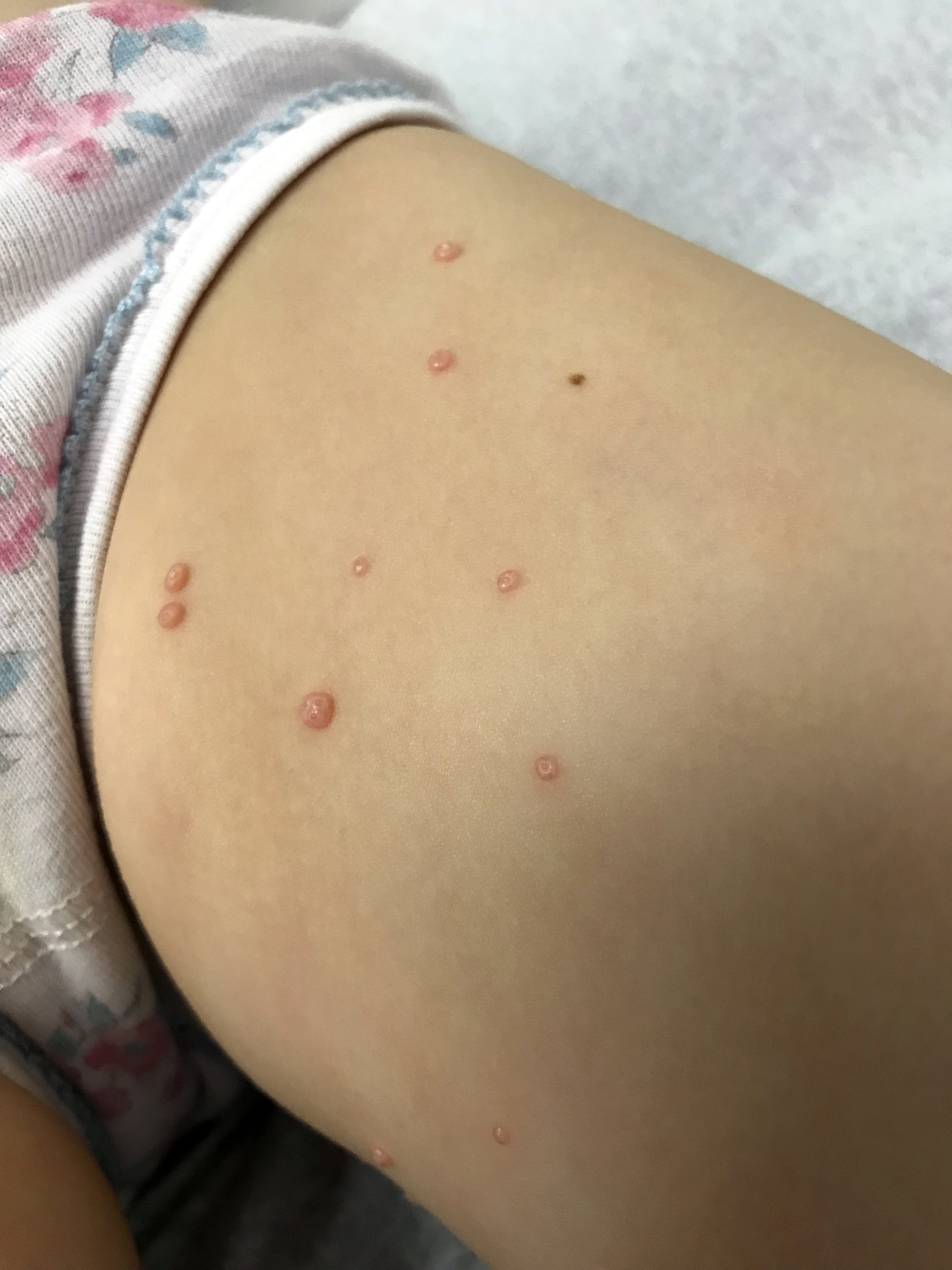 Molluscum contagiosum papules