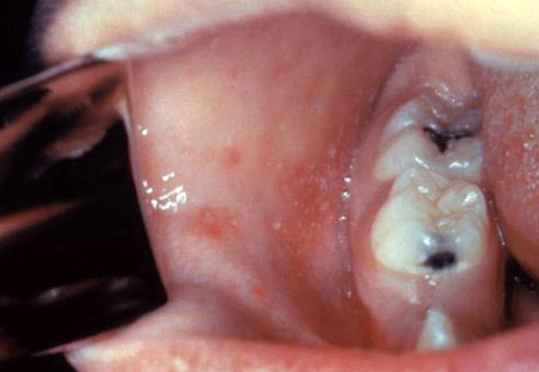 Koplik spots on buccal mucosa