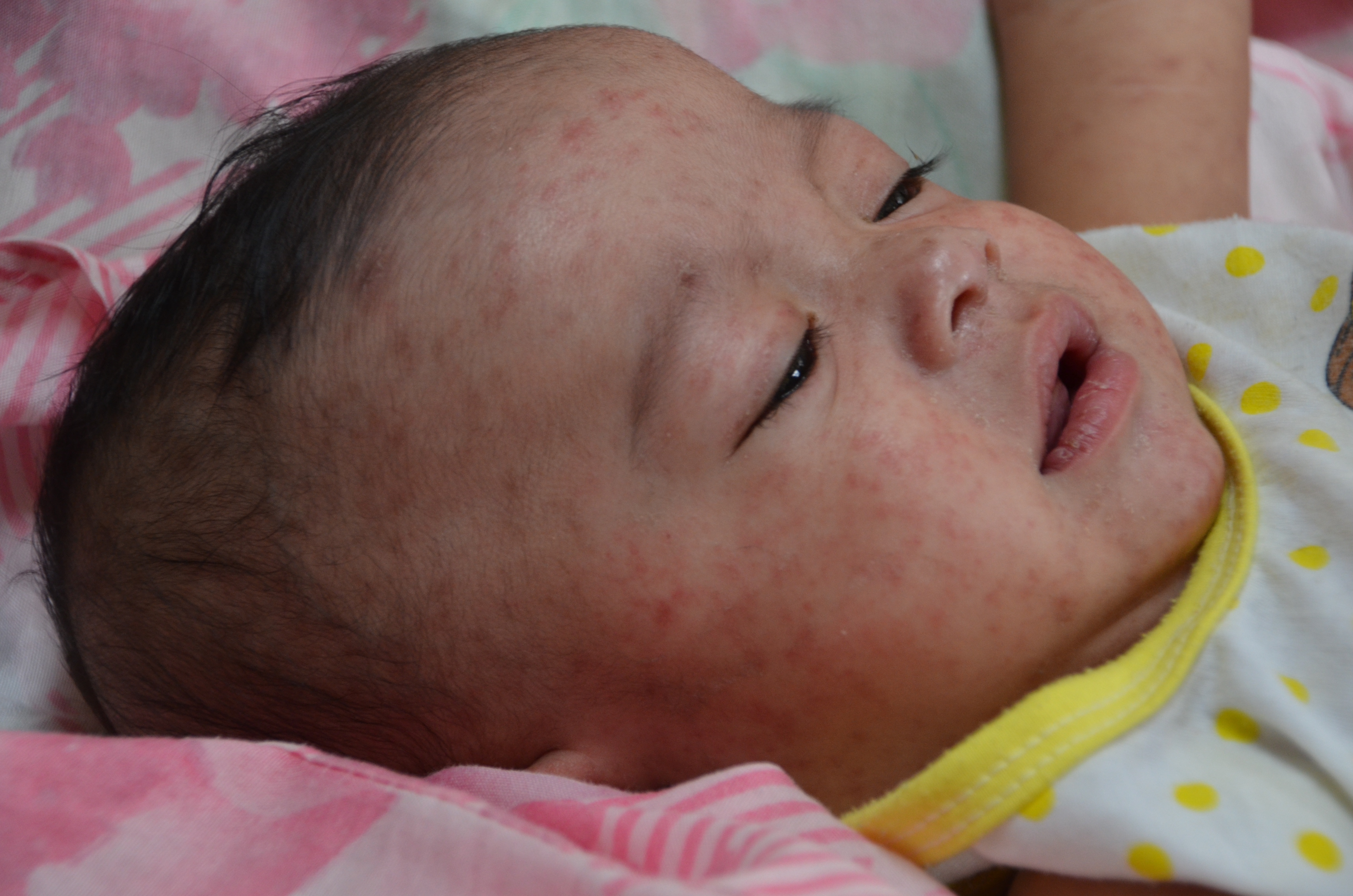 Measles maculopapular rash