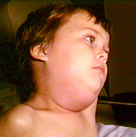 Bilateral parotid swelling in mumps