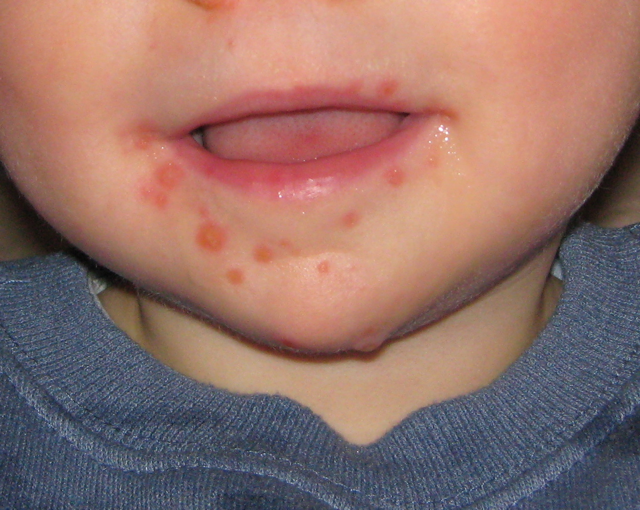 Hand-foot-mouth disease vesicles