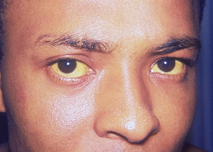 Jaundice (icterus)