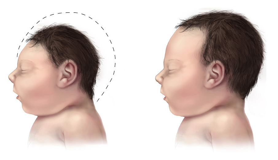 Microcephaly head circumference comparison