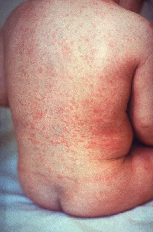 Rubella maculopapular rash on child back