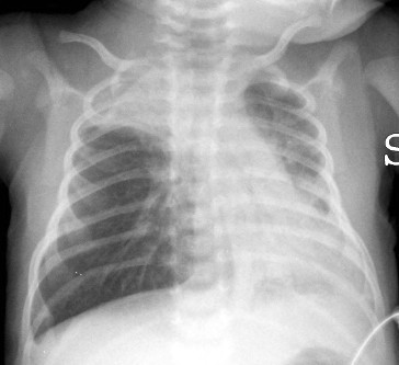 RSV (palivizumab target)