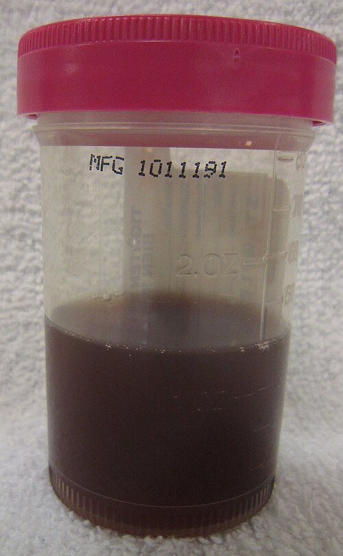 Gross hematuria urine specimen