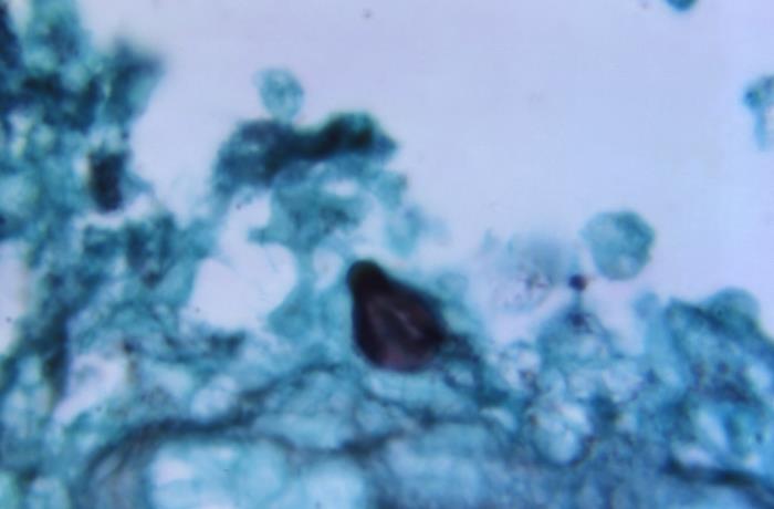 Burkitt lymphoma starry sky pattern (EBV)