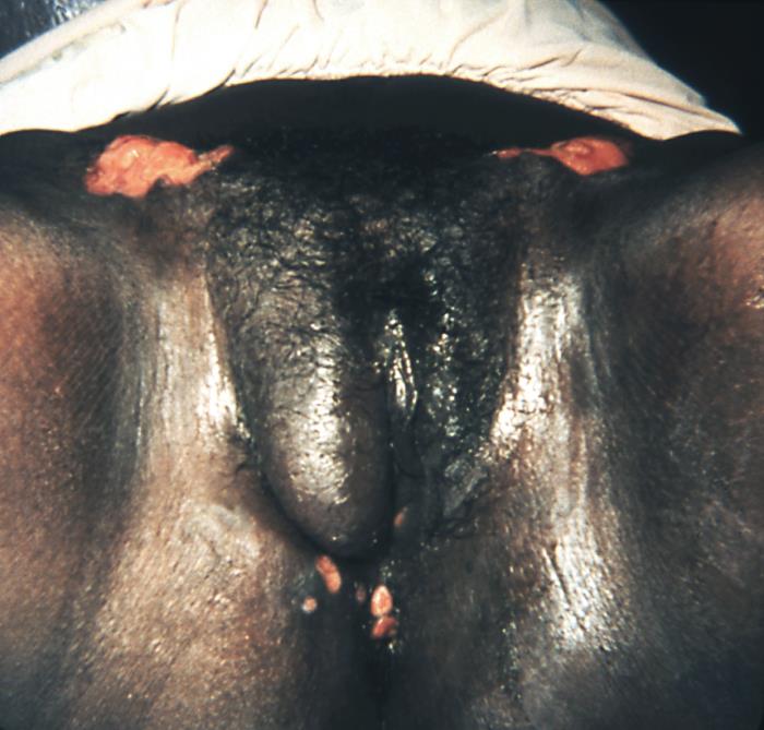 Condylomata lata (secondary syphilis)