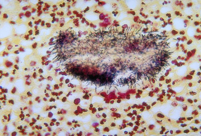 Hepatocellular carcinoma (HBV/HCV)