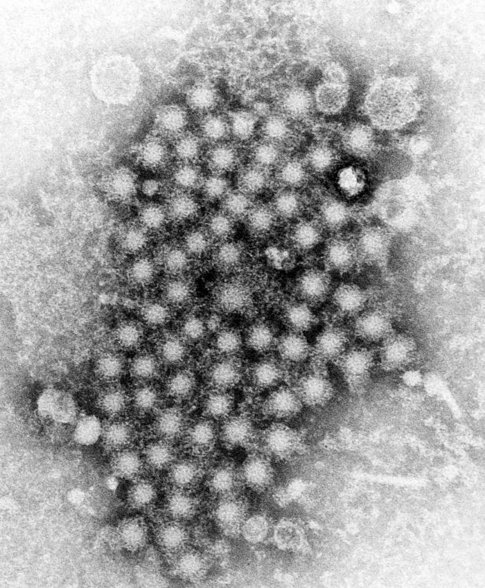 HCV chronic hepatitis liver biopsy