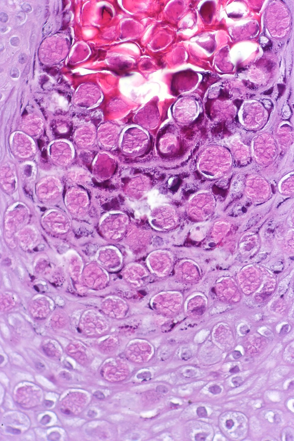 Henderson-Patterson bodies (Molluscum)