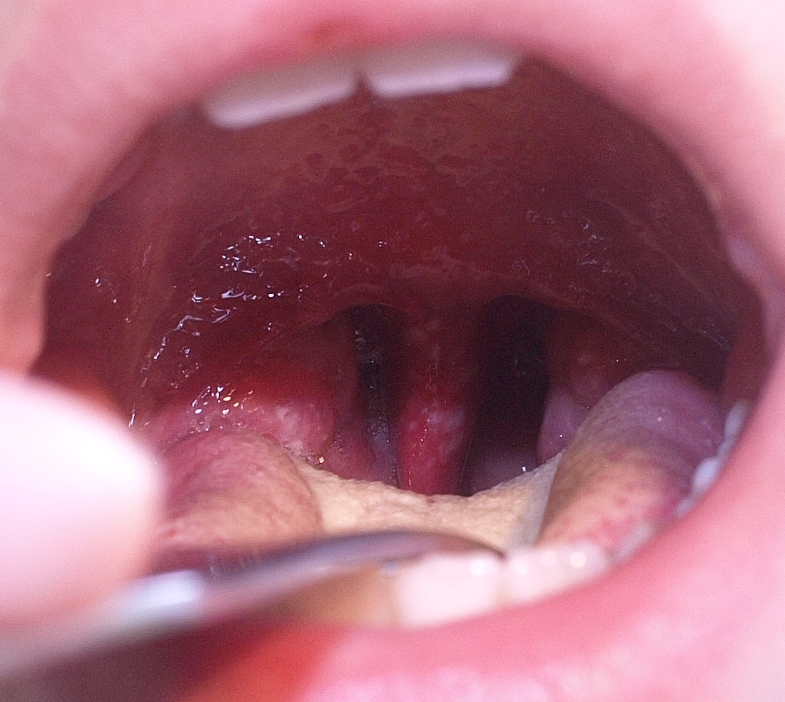 Herpangina vesicles on posterior pharynx