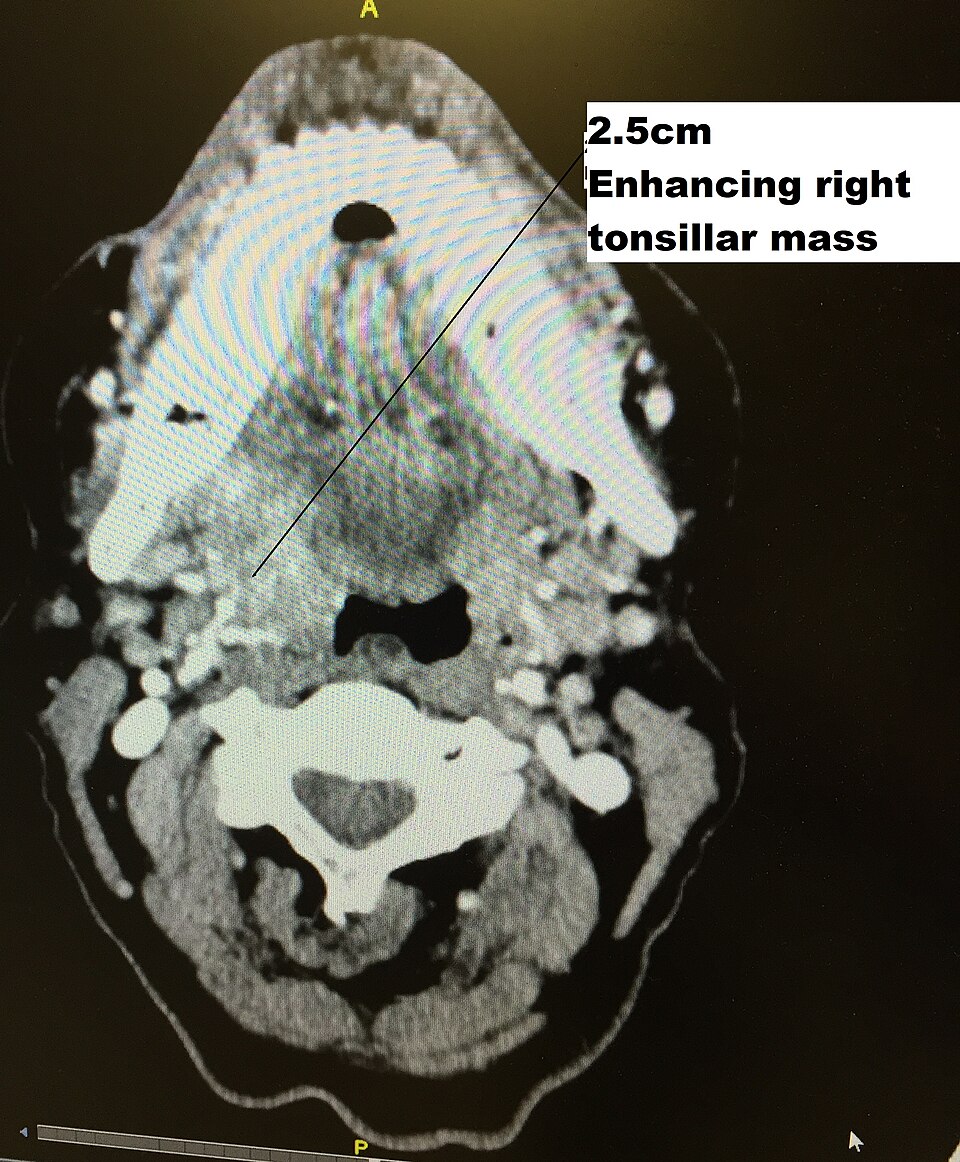 Oropharyngeal squamous cell carcinoma CT (HPV)