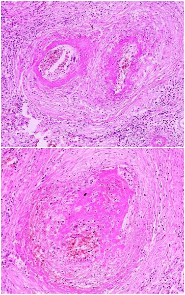 Polyarteritis nodosa (PAN)
