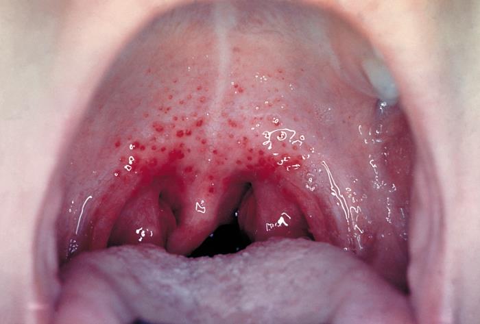 Scarlet fever sandpaper rash