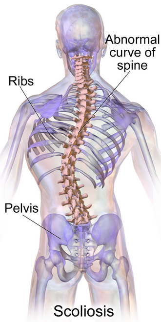 Scoliosis illustration showing lateral curvature of the spine