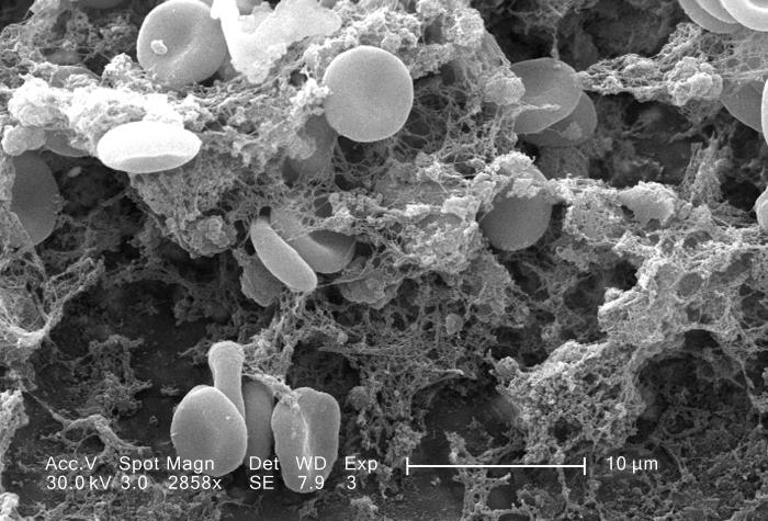 Blood clot structure under scanning electron microscopy