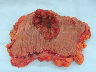 Colorectal adenocarcinoma