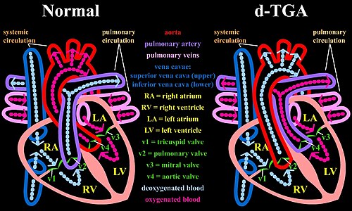 Transposition of the great arteries diagram
