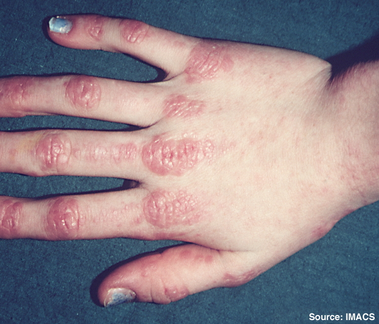 Gottron papules on knuckles
