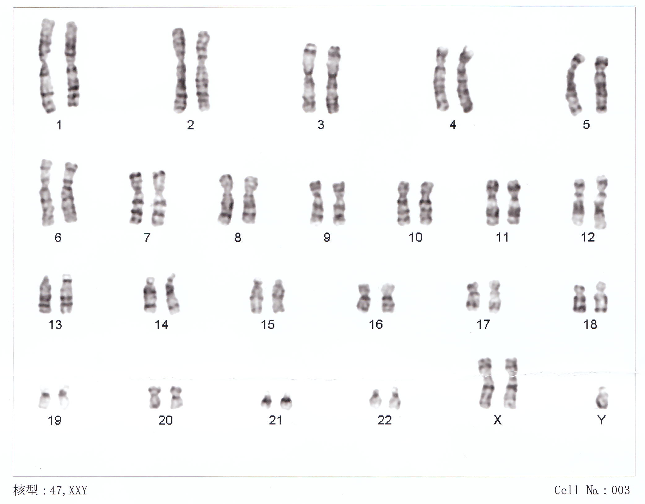 Klinefelter syndrome karyotype