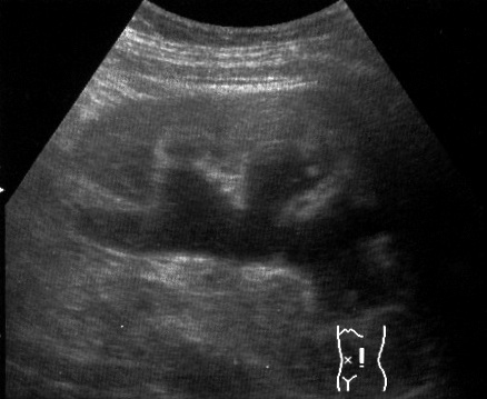 Hydrocephalus imaging