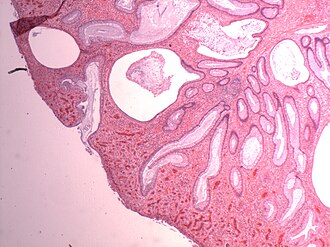 Juvenile polyp histology