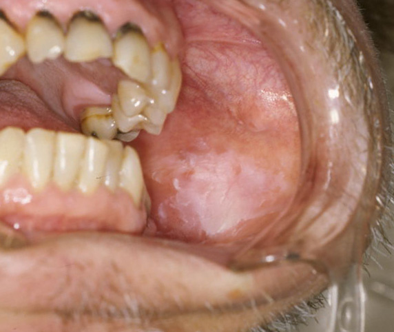 White oral plaque consistent with leukoplakia teaching image