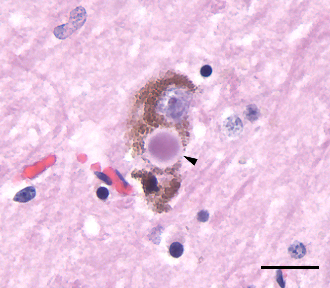 Lewy body inclusion in a substantia nigra neuron from a Parkinson's disease patient