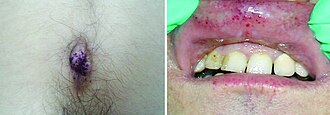 Angiokeratoma in Fabry disease