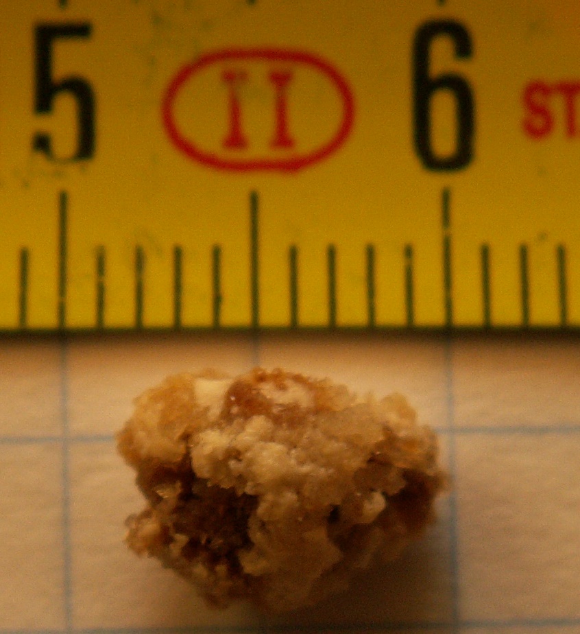 Gross ureteral stone specimen photographed beside a ruler for scale