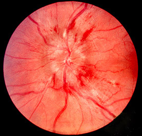 Fundus photograph showing papilledema with a swollen optic disc
