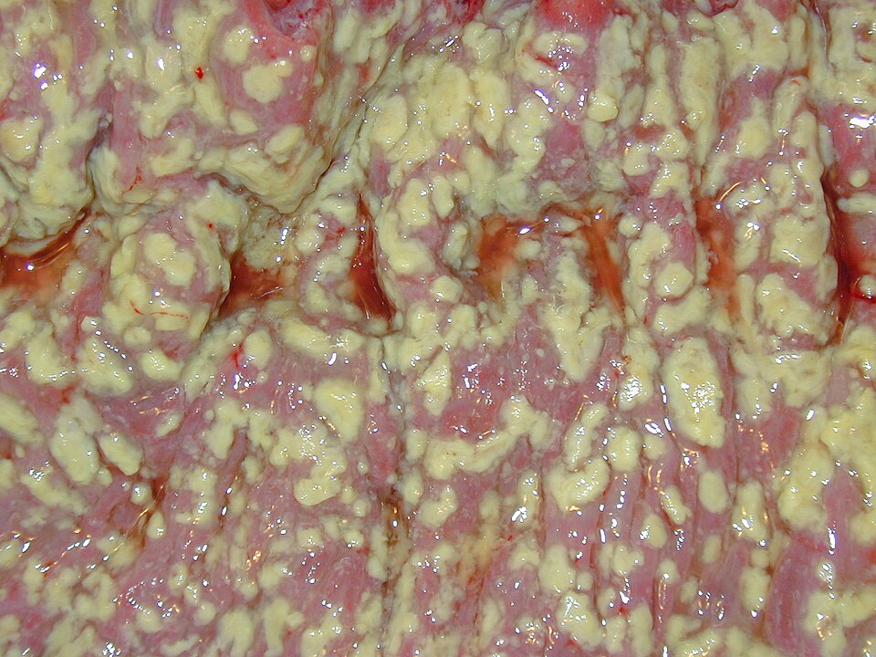 Pseudomembranous colitis with yellow plaques