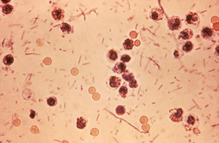 Stool smear with fecal leukocytes (neutrophils) in Shigella dysentery