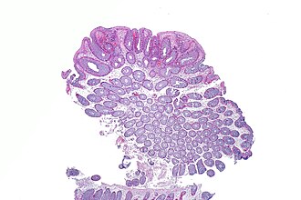 Tubular adenoma histology