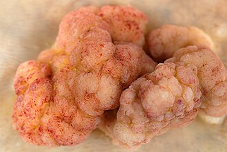 Villous adenoma histology