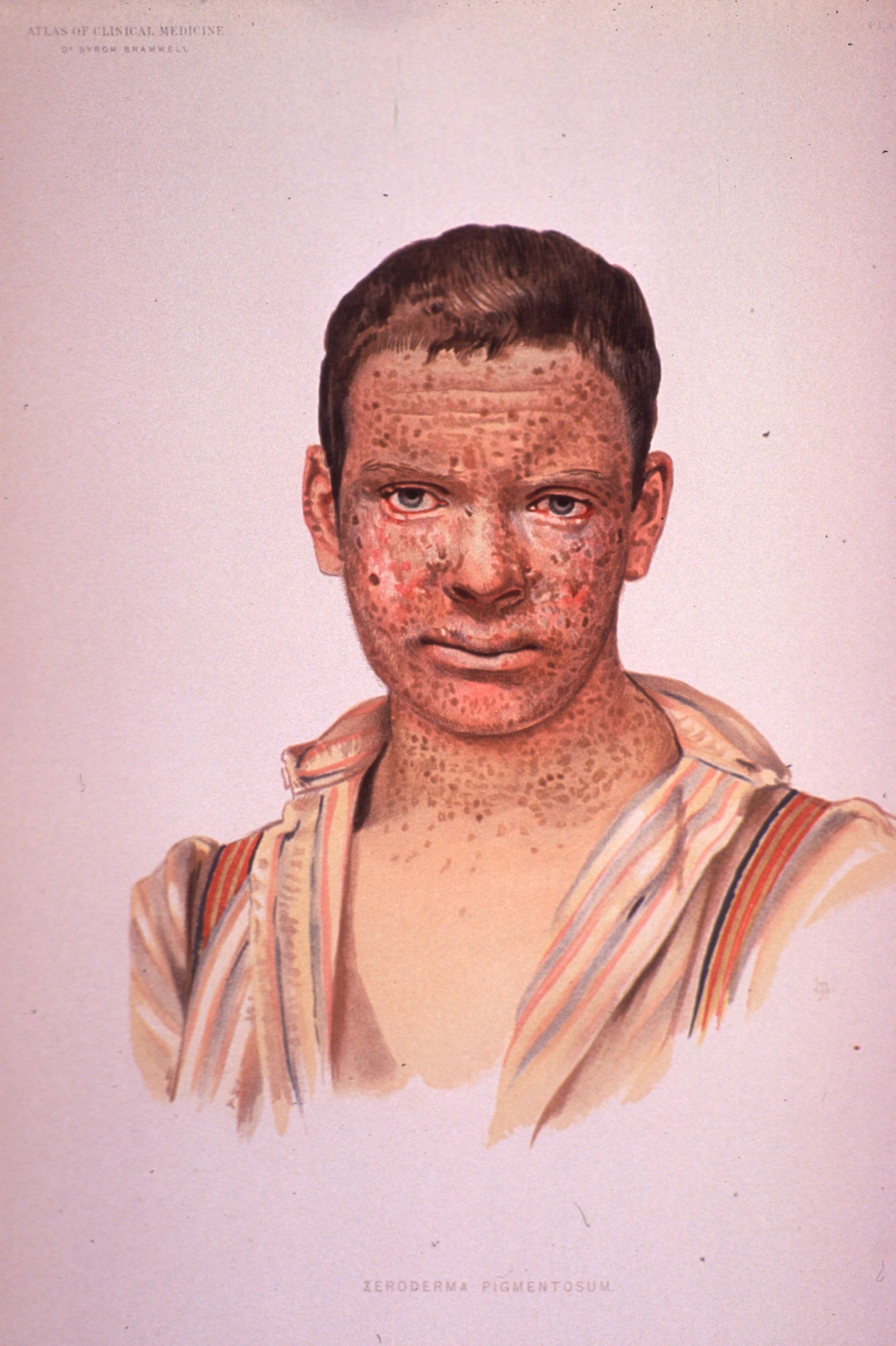 XP periorbital erythema