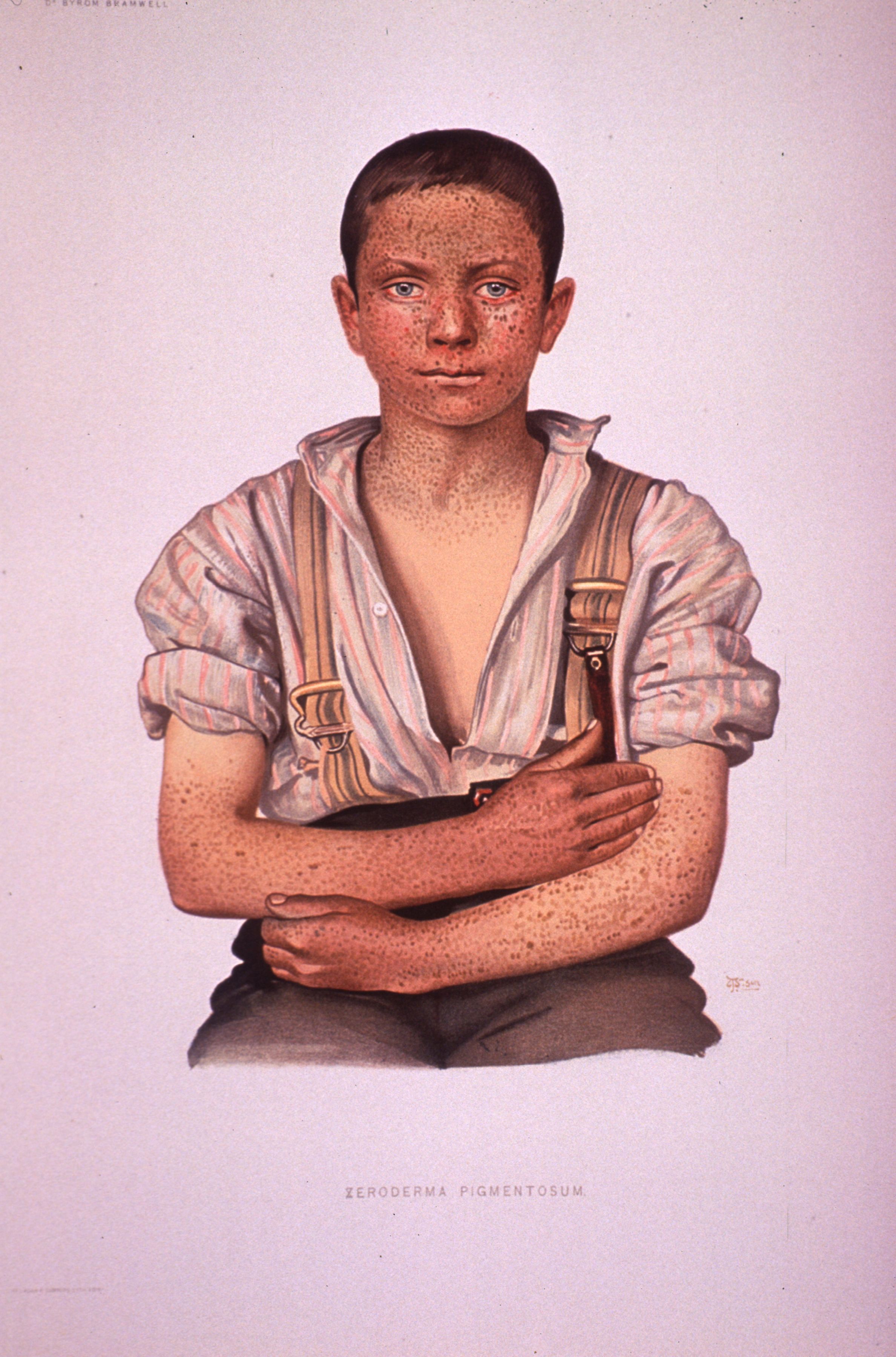 XP scaling erythema