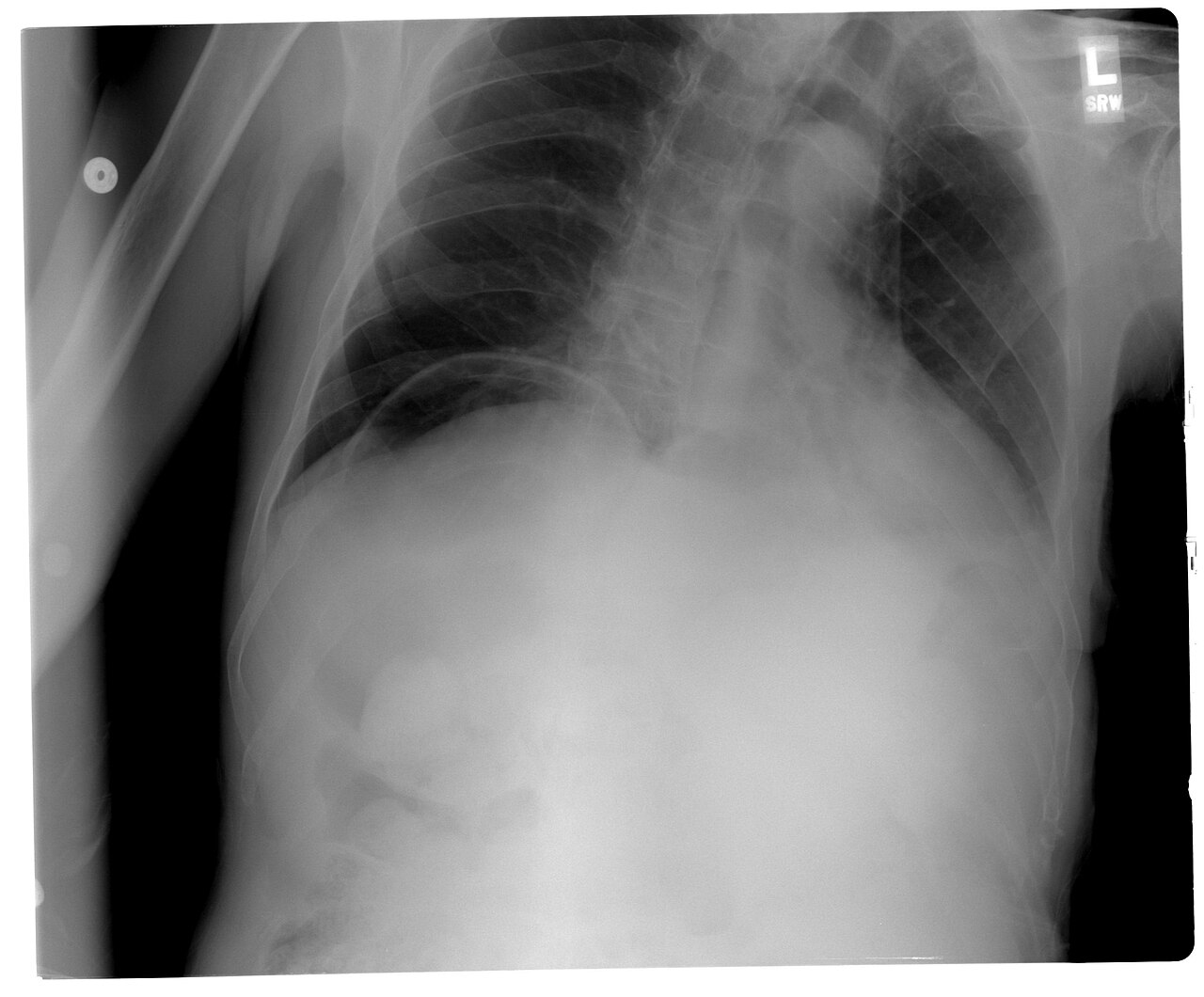 Upright chest X-ray showing free air under the diaphragm (pneumoperitoneum)