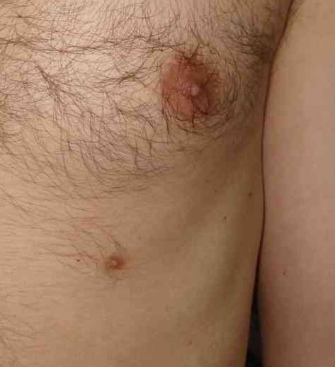 Accessory (supernumerary) nipple on the chest, sitting along the embryologic milk line below the normal nipple