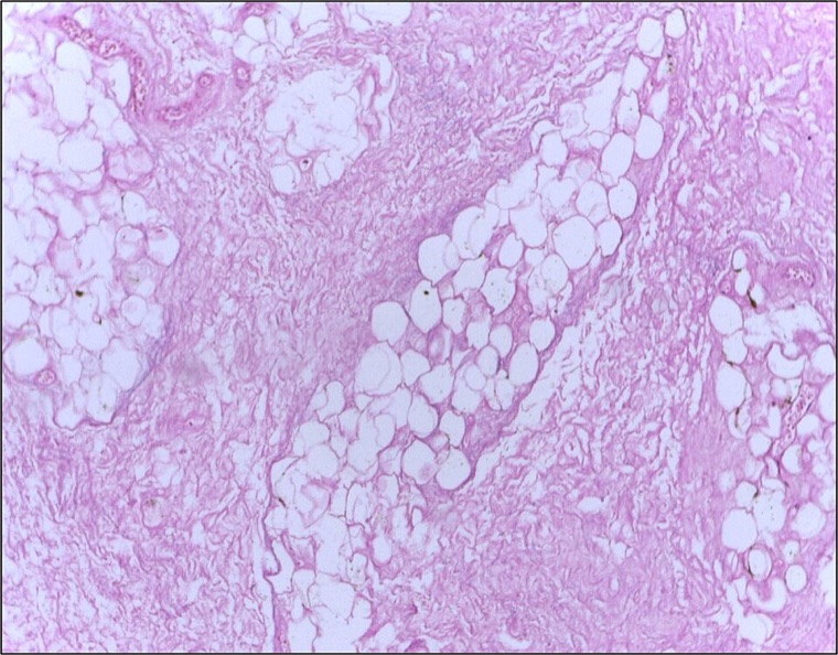 Histopathology of breast fat necrosis showing lipid-laden macrophages and fat-laden cyst spaces without malignant cells