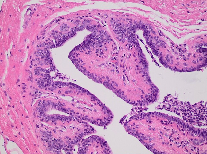 Histopathology of an intraductal papilloma: a benign papillary growth with fibrovascular cores projecting into a dilated breast duct