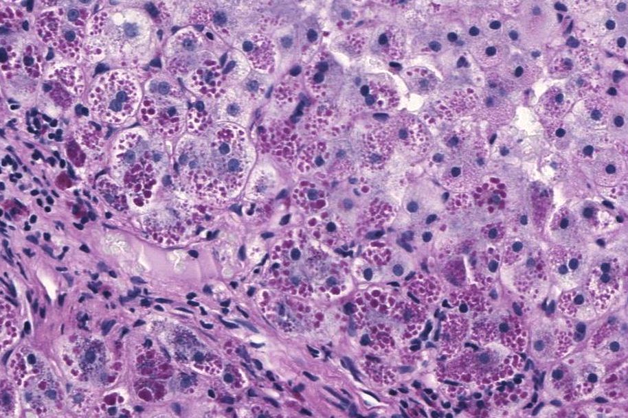 Liver biopsy with PAS-positive diastase-resistant alpha-1 antitrypsin globules
